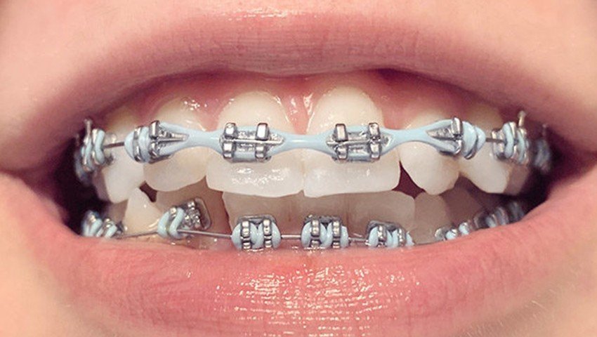 Chun chuỗi niềng răng là gì? Lưu ý và cách sử dụng