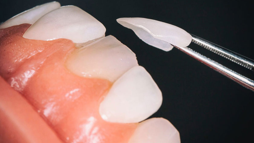 dan-su-veneer-khong-mai-rang-3