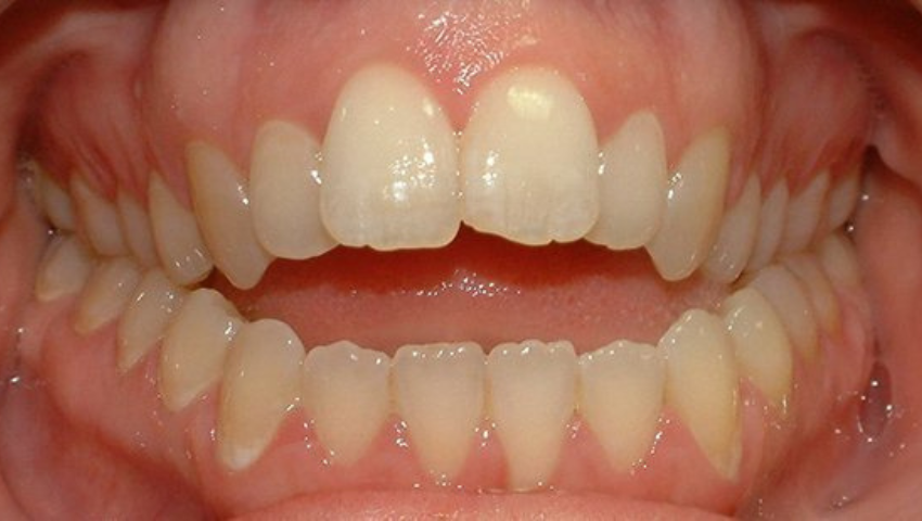 Khớp cắn hở là gì? Nguyên nhân và cách điều trị