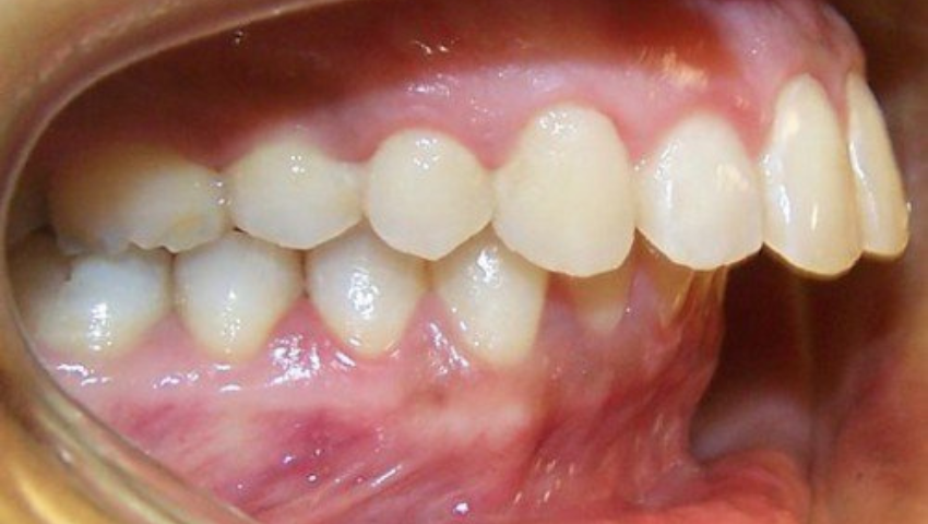 khop-can-sau-la-gi-2