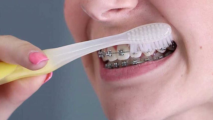 kinh-nghiem-nieng-rang-1