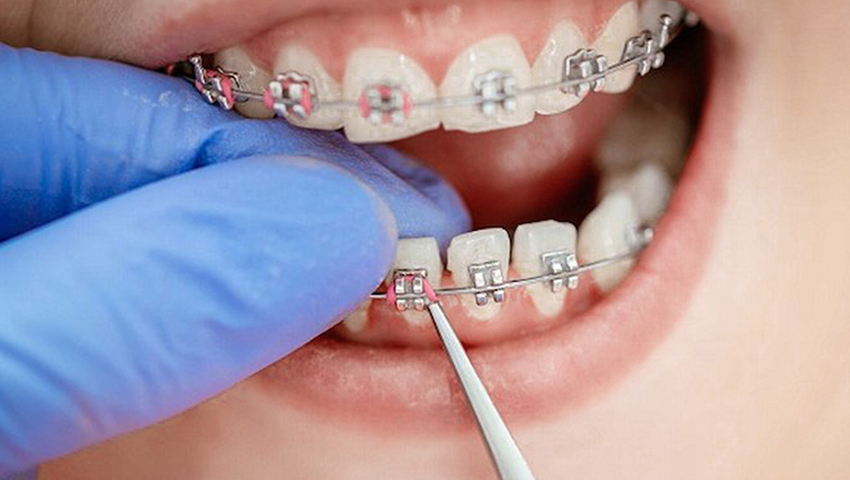 kinh-nghiem-nieng-rang-2