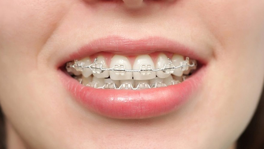 kinh-nghiem-nieng-rang