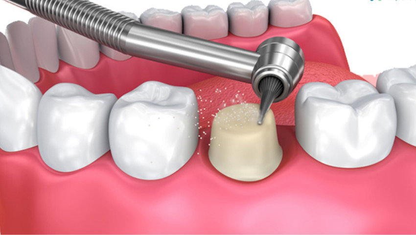 lam-cau-rang-su-co-dau-khong-1