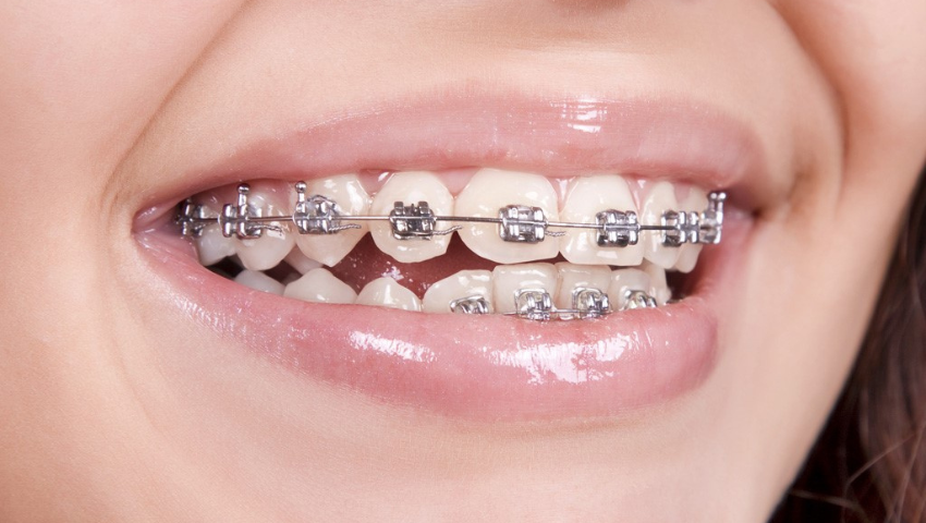 Giải đáp: Làm cầu răng sứ có niềng răng được không?