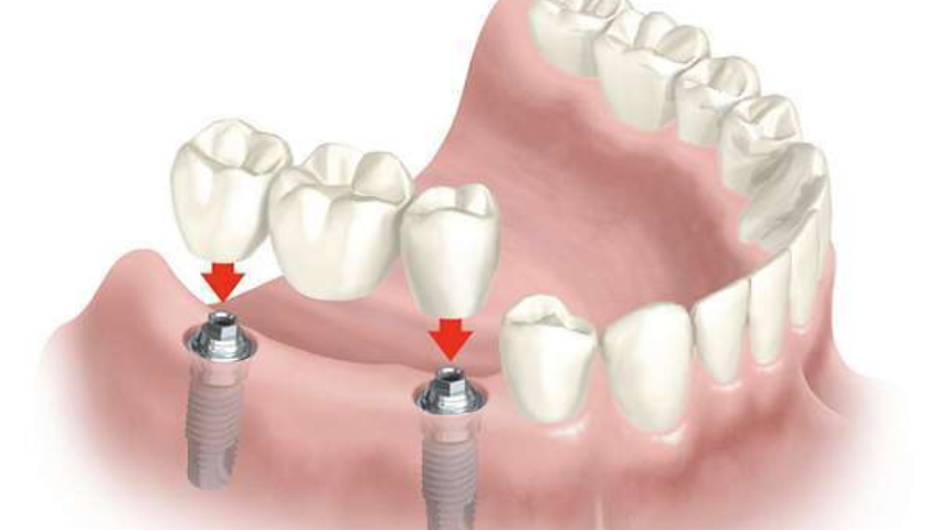lam-cau-rang-su-co-nieng-rang-duoc-khong-3