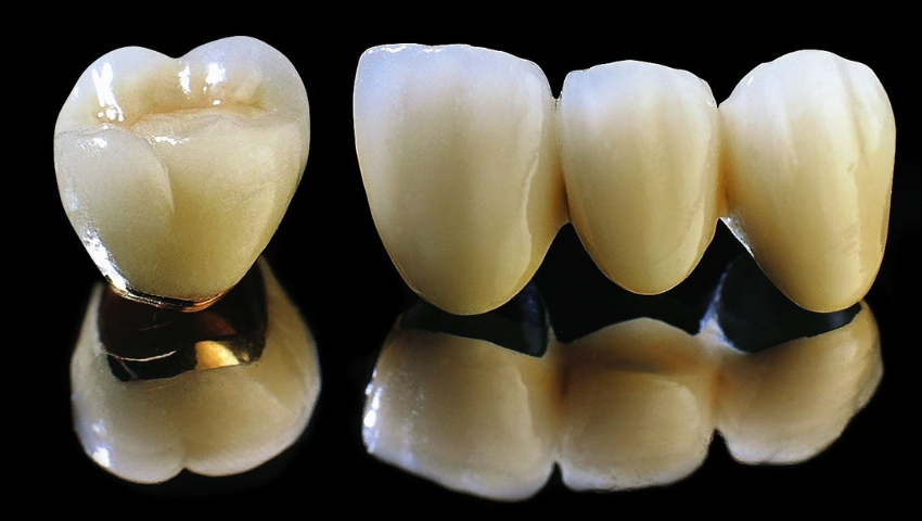 lam-cau-rang-su-su-dung-duoc-bao-lau-2