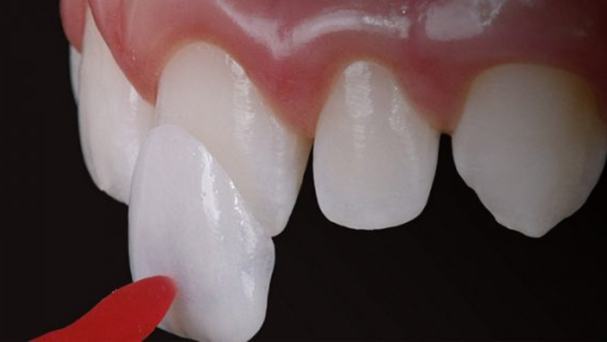 mat-dan-su-veneer- zirconia-1
