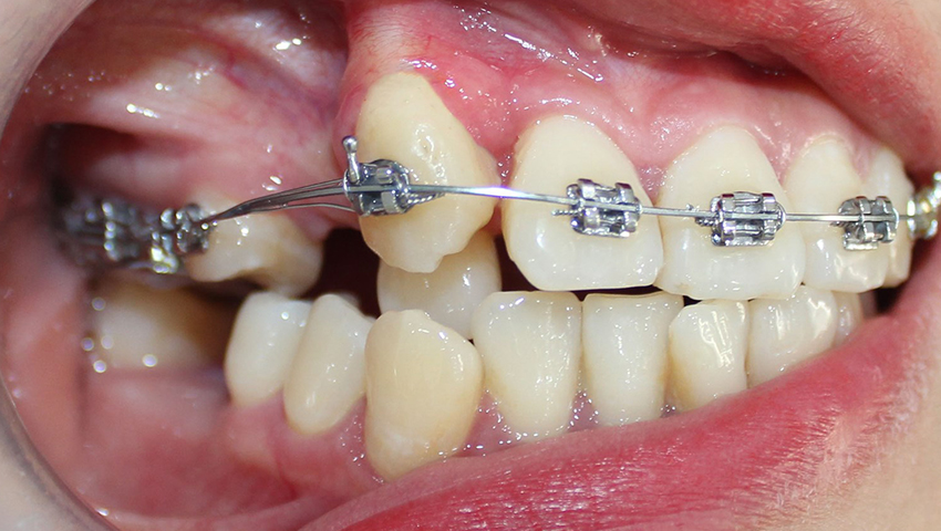 mat-rang-so-6-co-nieng-rang-duoc-khong-1