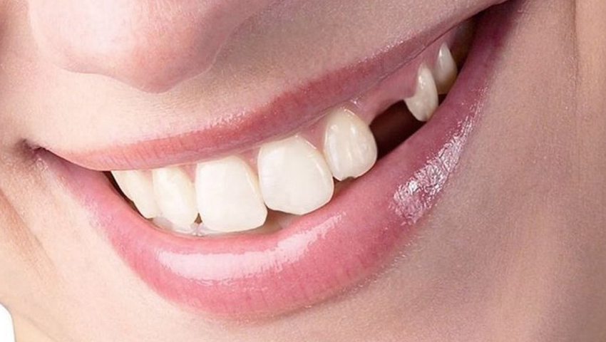 mat-rang-so-6-co-nieng-rang-duoc-khong