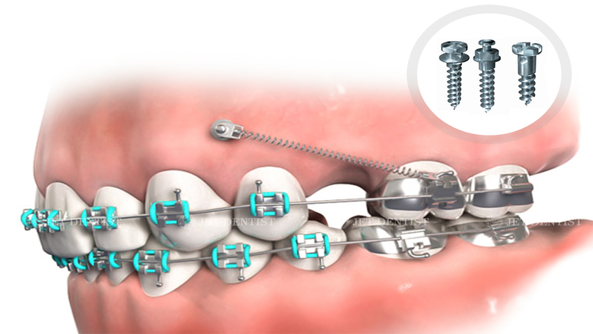 Minivis niềng răng là gì? Những trường hợp cần cắm minivis trong niềng răng