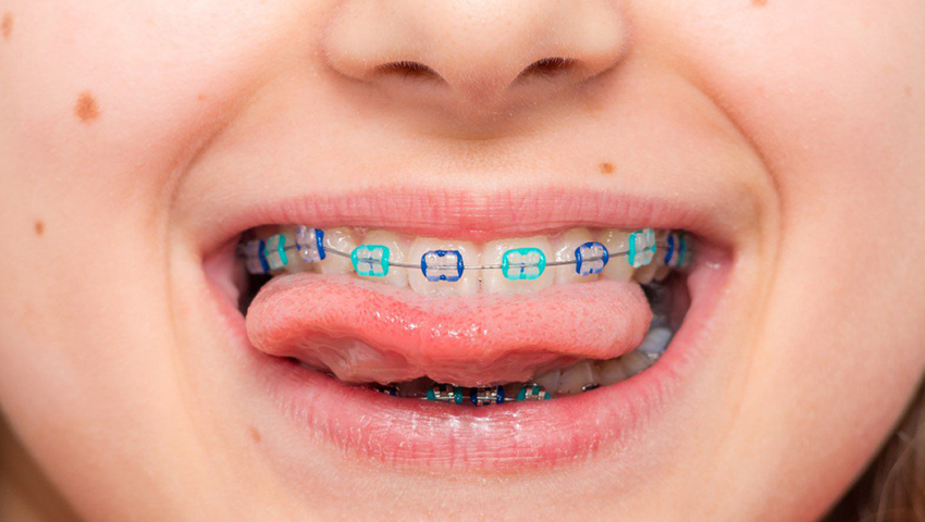 Niềng răng cho bé 7 tuổi bao nhiêu tiền? 