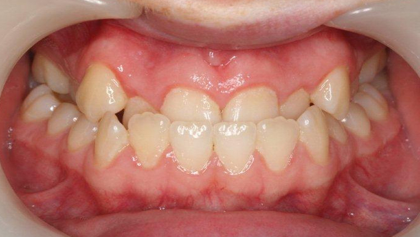 Niềng răng khớp cắn ngược nên lựa chọn phương pháp nào? 