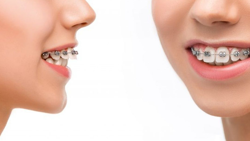 Giải đáp: Niềng răng xong có bị chạy lại không?