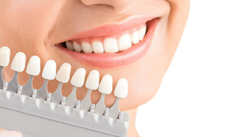 quy-trinh-dan-su-veneer-2