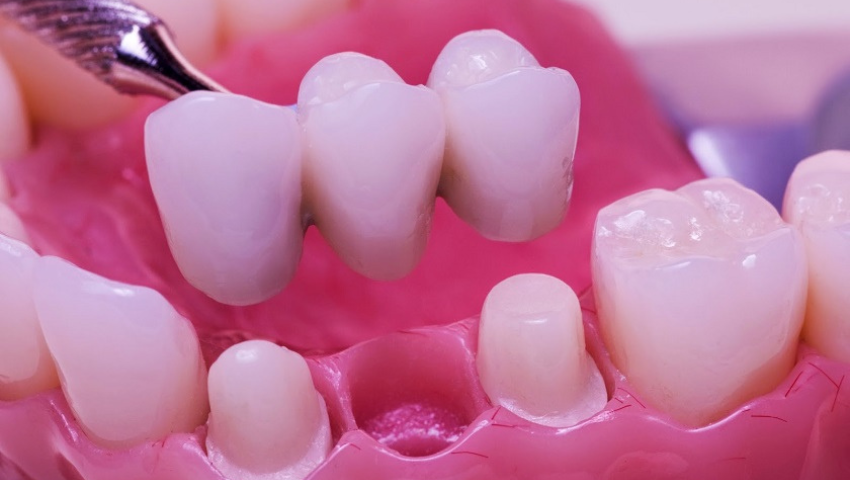 quy-trinh-lam-cau-rang-su-1