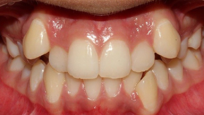 rang-khap-khenh-la-gi-1