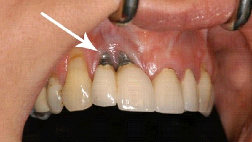 tac-dung-phu-cua-trong-rang-implant-1