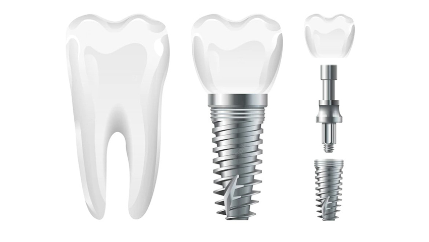 tac-dung-phu-cua-trong-rang-implant