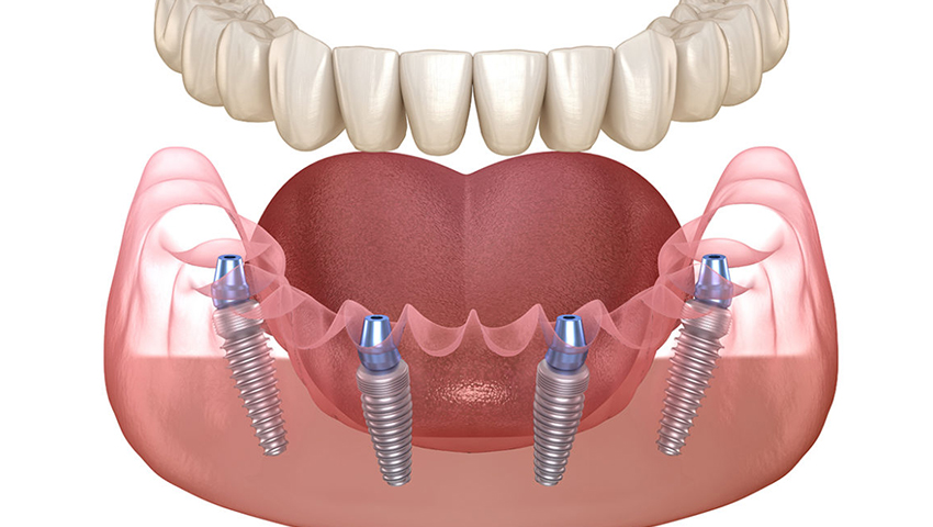 trong-rang-implant-co-dau-khong-1