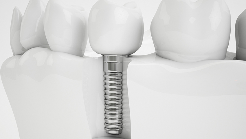 trong-rang-implant-co-dau-khong