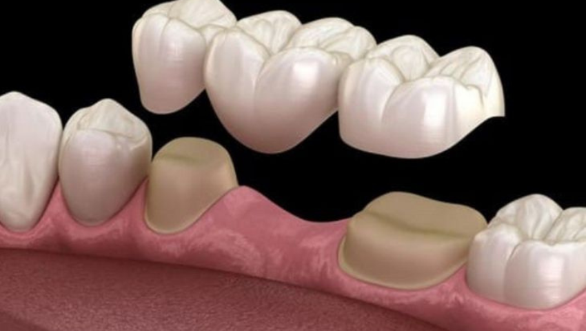 trong-rang-su-bac-cau-3