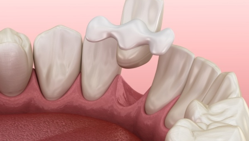 Trồng răng sứ với phương pháp cầu răng có sử dụng mãi mãi được không?