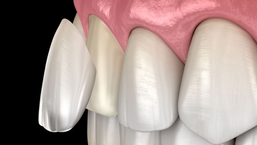 uu-nhuoc-diem-cua-dan-su-veneer-1