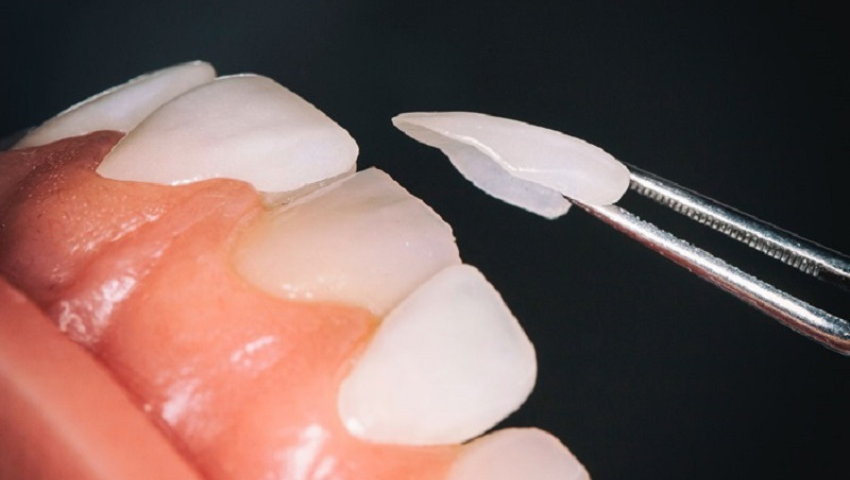 uu-nhuoc-diem-cua-dan-su-veneer-2