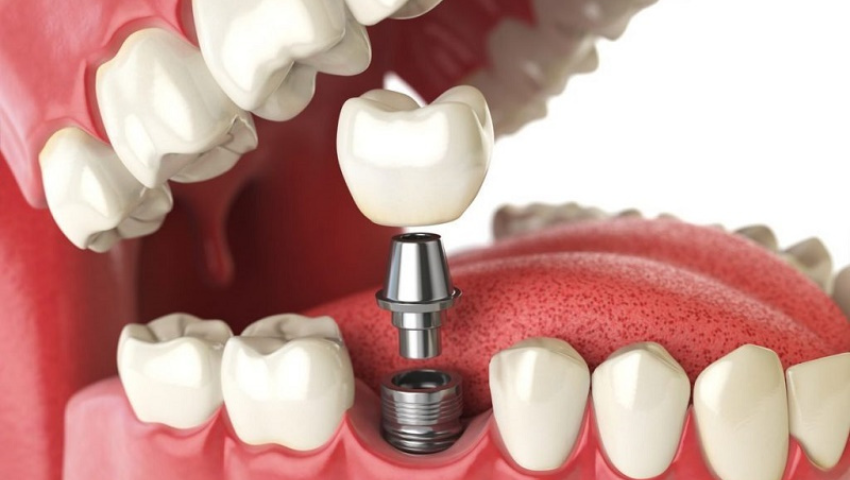 luu-y-khi-trong-rang-implant-1