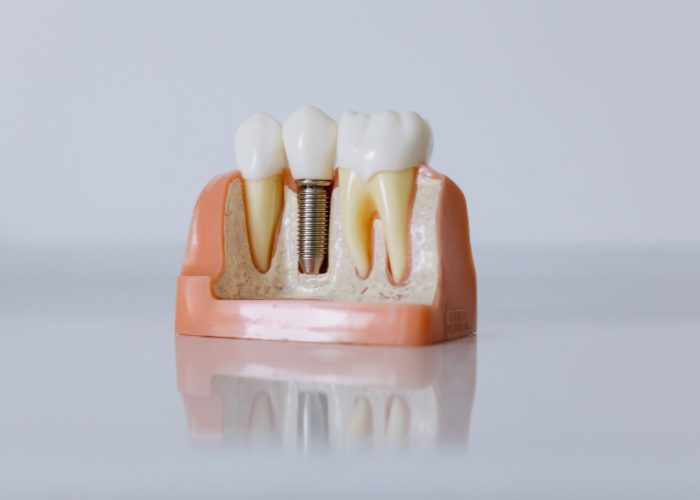 Những lưu ý sau khi trồng răng Implant