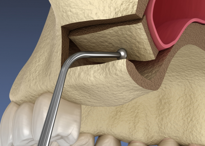 Nâng xoang hở trong trồng răng Implant và những điều cần biết 