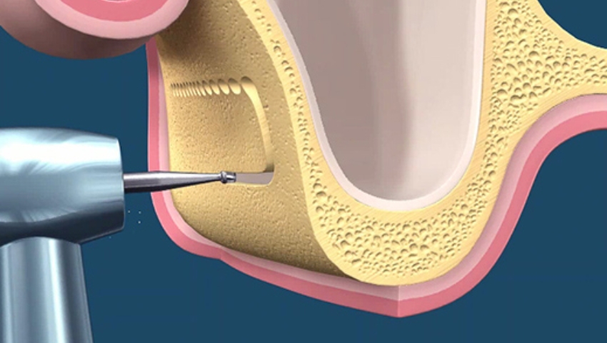 nang-xoang-kin-va-nang-xoang-ho-3
