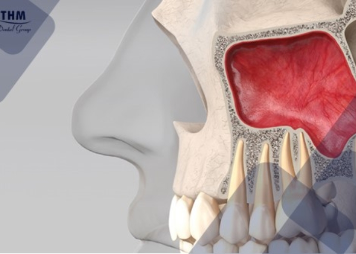 Hiểu rõ về nâng xoang kín và nâng xoang hở trong trồng răng Implant