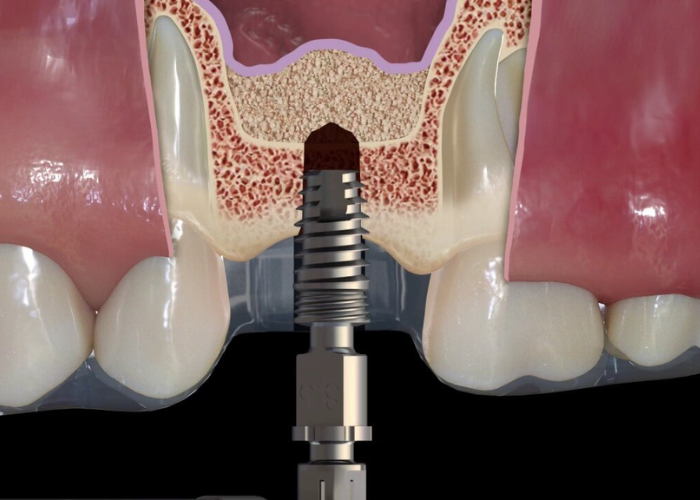 Nâng xoang kín trong trồng răng implant và những lưu ý quan trọng