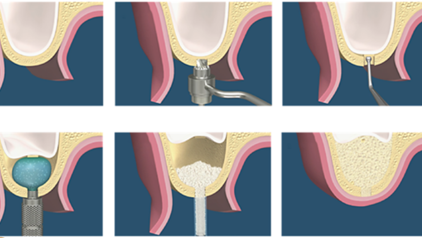nang-xoang-trong-cay-ghep-implant-1