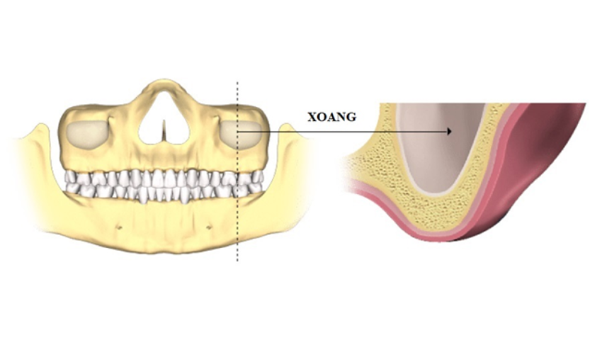 nang-xoang-trong-cay-ghep-implant