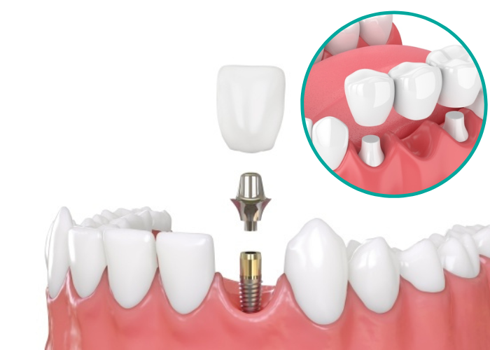 Tư vấn: Nên trồng răng sứ hay Implant
