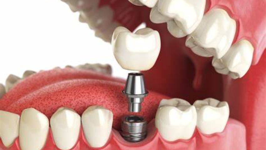 trong-rang-implant-cong-nghe-moi-1