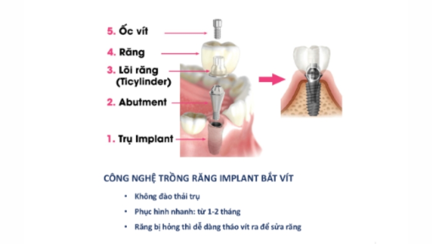trong-rang-implant-cong-nghe-moi-2