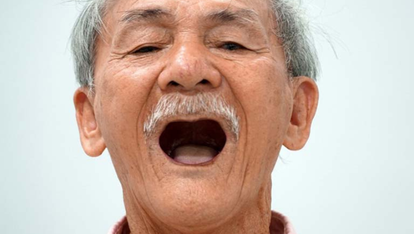 trong-rang-implant-nguyen-ham-gia-bao-nhieu-1