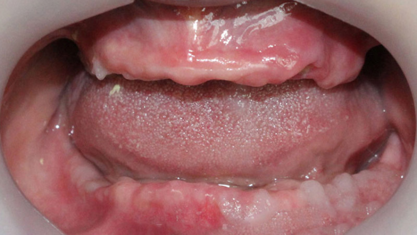 trong-rang-implant-nguyen-ham-gia-bao-nhieu-2