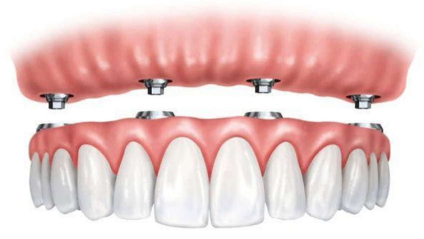 trong-rang-implant-nguyen-ham-gia-bao-nhieu-4