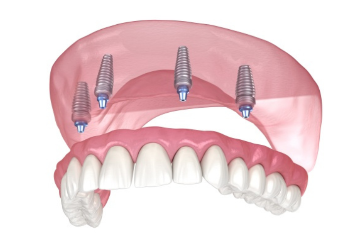 Trồng răng Implant nguyên hàm giá bao nhiêu?