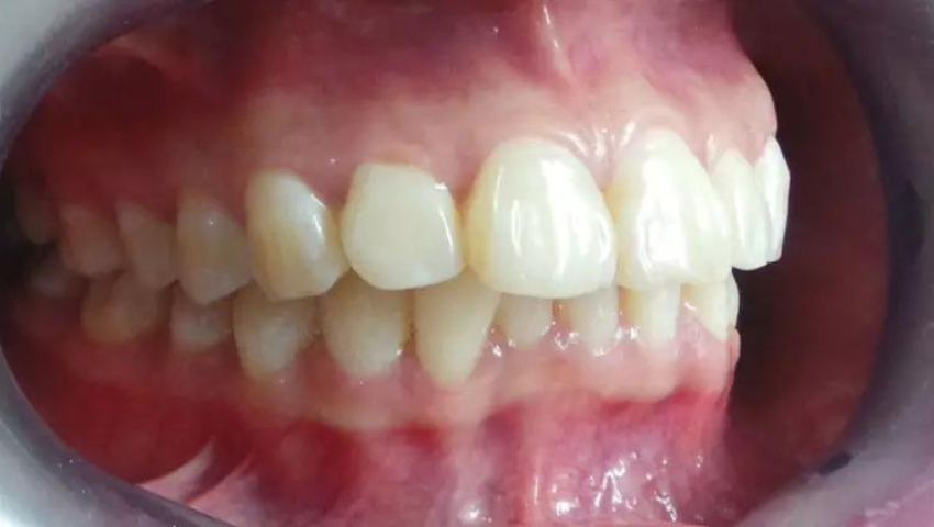 bien-chung-sau-khi-boc-rang-su-3