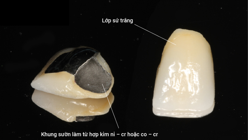 boc-rang-su-1-chiec-duoc-khong-3
