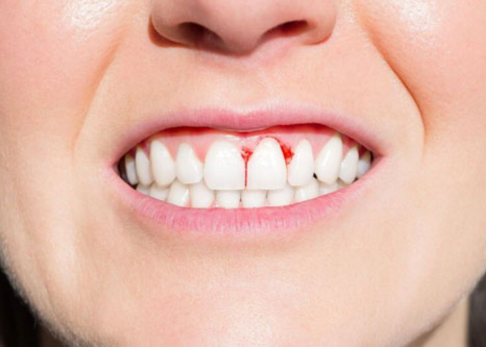 Những biến chứng của bọc răng sứ bị lệch khớp cắn