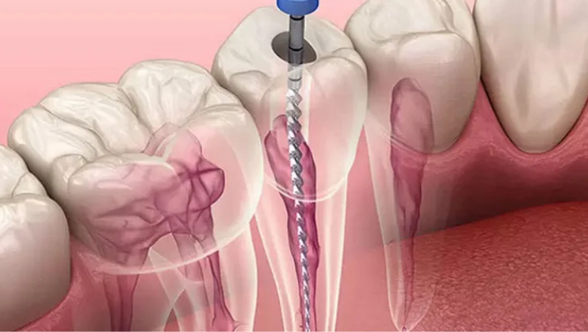 boc-rang-su-bi-viem-tuy-1