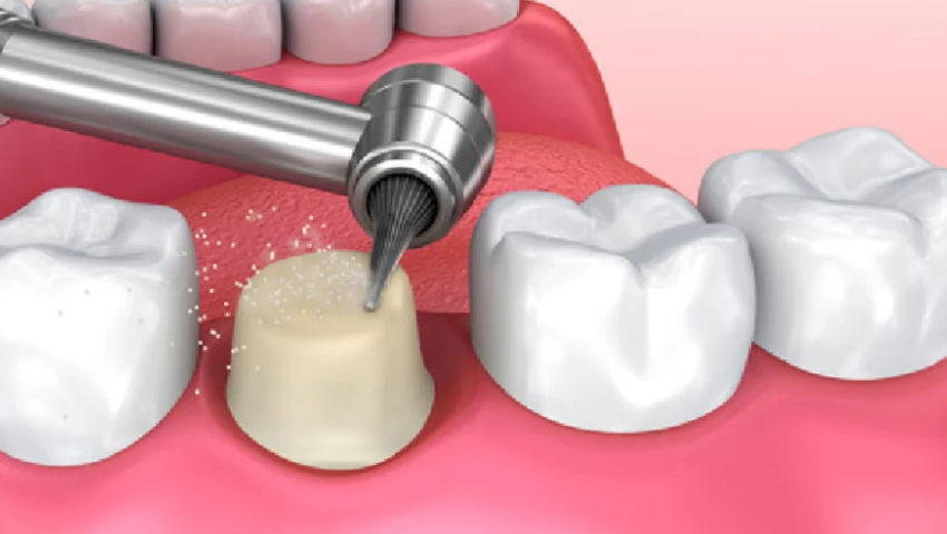 boc-rang-su-bi-viem-tuy-2