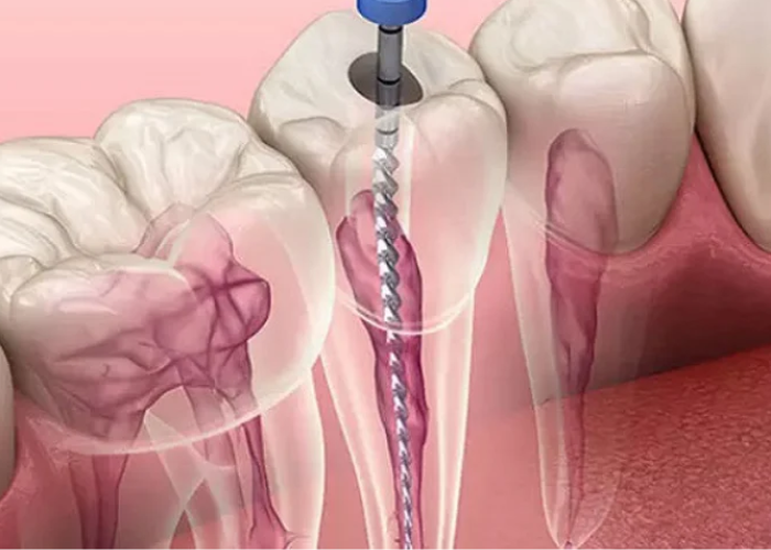 Răng bọc sứ bị viêm tủy nguyên nhân do đâu?